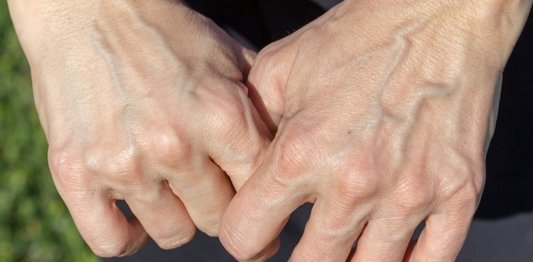 hand veins prominent in some people
