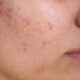 Acne – The Literal Pain on the Face